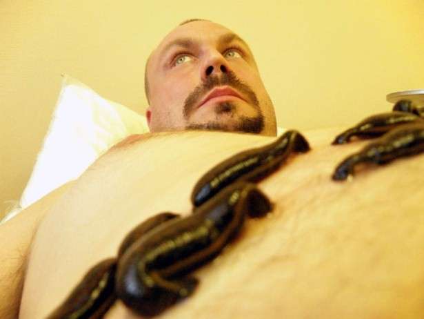 Leech Therapy