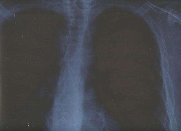 After  Chemotherapy And Prognosis X-Ray - Primary Mediastinal Nonseminomatous Germ Cell Tumour