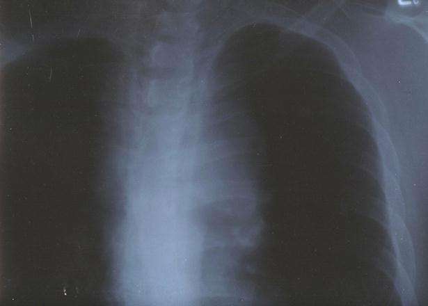 Before Cancer X-Ray