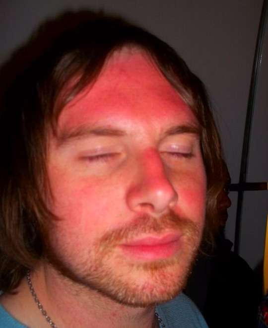 Sunburn